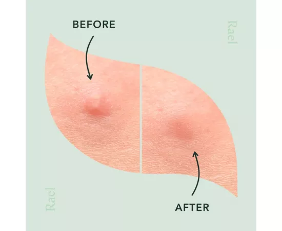 Rael Beauty Miracle Patch Microcrystal Spot Cover